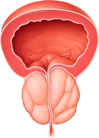 crecimientoprostatico