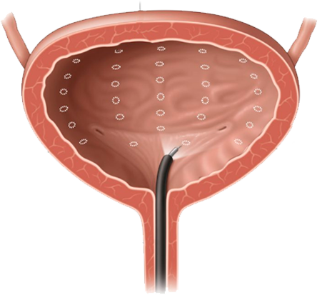 hiperactividadvesical